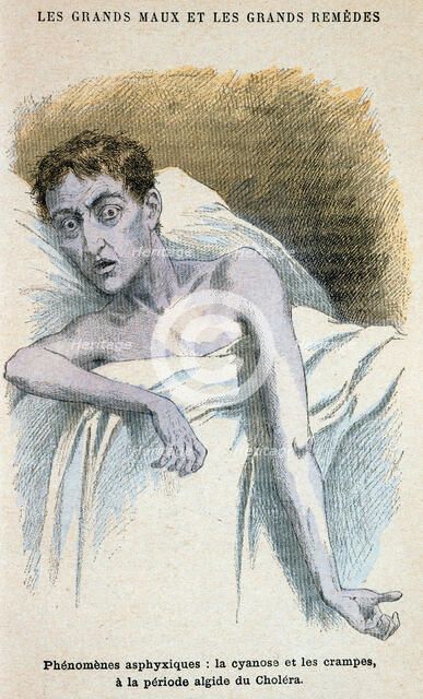 Cholera patient. Artist: Unknown