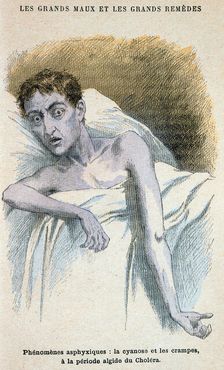 Cholera patient