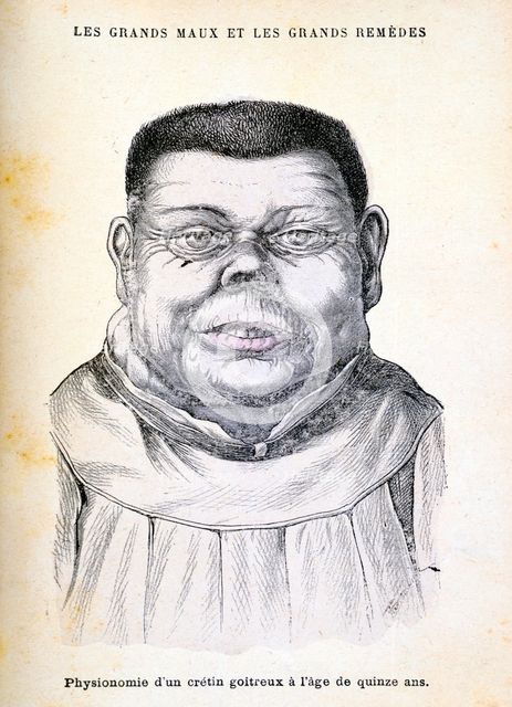 Cretin aged 15, c1890. Creator: Unknown.