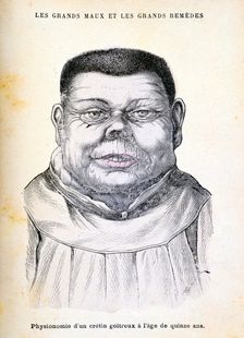 Cretin aged 15, c1890. Creator: Unknown