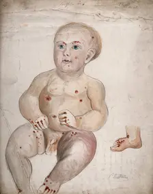 A three month old baby boy with diseased skin and sores on his face and body..., between 1800 & 1899 Creator: Christopher D'Alton