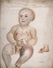A three month old baby boy with diseased skin and sores on his face and body..., between 1800 & 1899 Creator: Christopher D'Alton