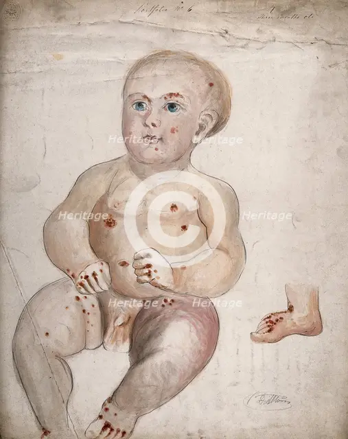 A three month old baby boy with diseased skin and sores on his face and body..., between 1800 & 1899 Creator: Christopher D'Alton.