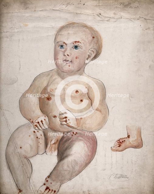 A three month old baby boy with diseased skin and sores on his face and body..., between 1800 & 1899 Creator: Christopher D'Alton.