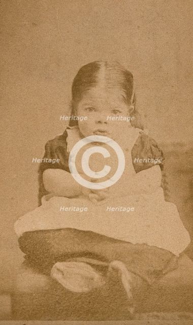 A very young girl, showing signs of mental deficiency, seated with her hands clasped upon her lap. Creator: William Moscrop.