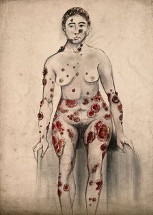 A woman suffering from open sores and abcesses on her face and entire body, 1867. Creator: Christopher D'Alton