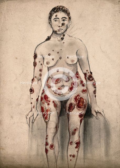 A woman suffering from open sores and abcesses on her face and entire body, 1867. Creator: Christopher D'Alton.