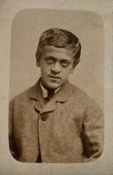 A young man, probably showing some signs of Down's syndrome, c1880s. Creator: Davis & Sons