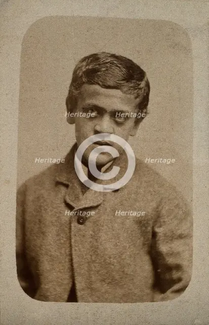 A young man, probably showing some signs of Down's syndrome, c1880s. Creator: Davis & Sons.