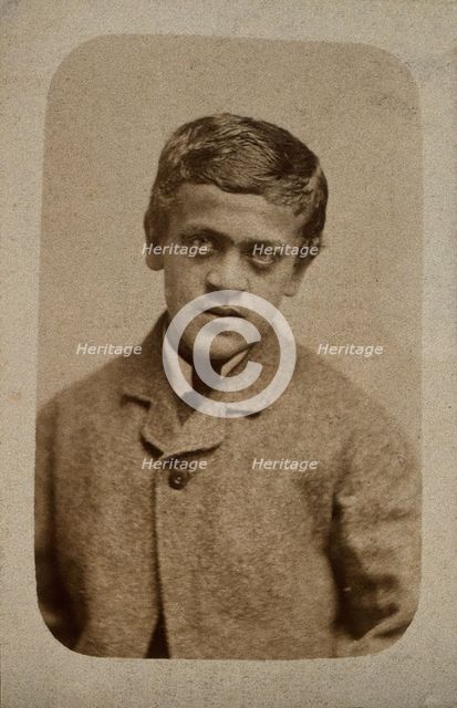 A young man, probably showing some signs of Down's syndrome, c1880s. Creator: Davis & Sons.