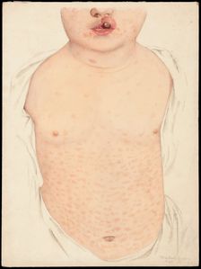 A boy with a congenital deformity of the mouth and a rash on the trunk, Feb 16th 1901. Creator: Mabel Green