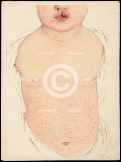 A boy with a congenital deformity of the mouth and a rash on the trunk, Feb 16th 1901. Creator: Mabel Green.