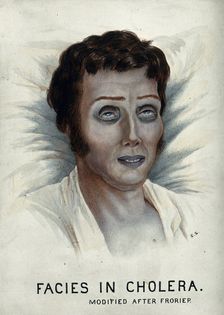 A cholera victim with a typical facial appearance, 1920-1950. Creator: Unknown