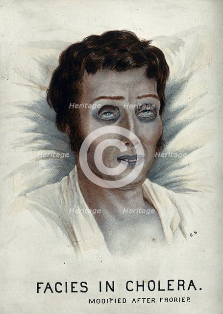 A cholera victim with a typical facial appearance, 1920-1950. Creator: Unknown.