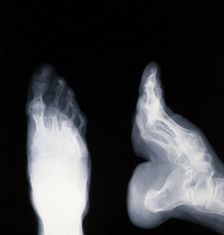 A deformed foot: X-ray, 20th century. Creator: Unknown