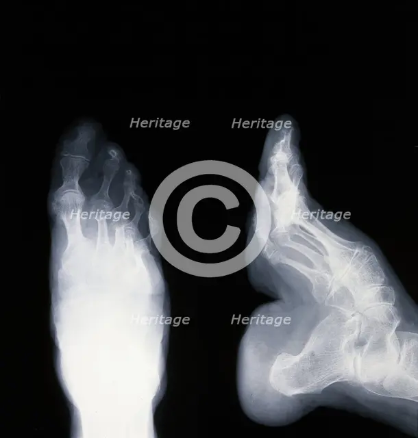 A deformed foot: X-ray, 20th century. Creator: Unknown.