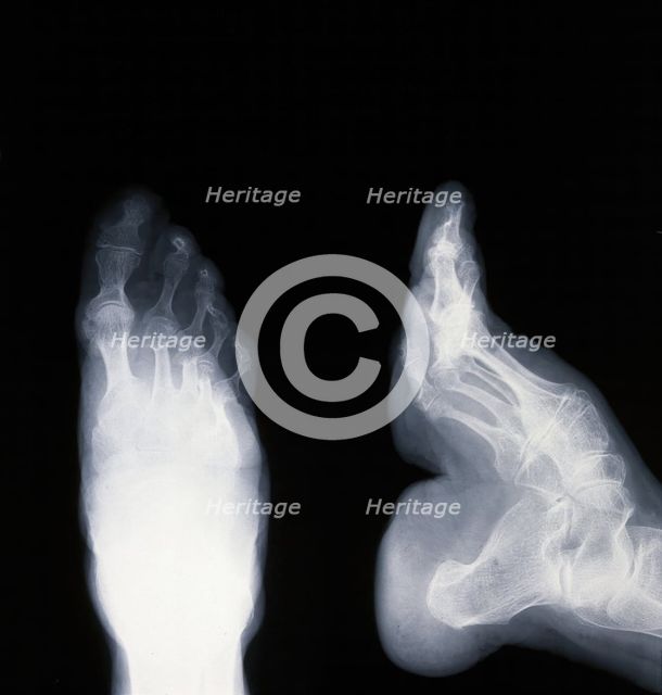 A deformed foot: X-ray, 20th century. Creator: Unknown.