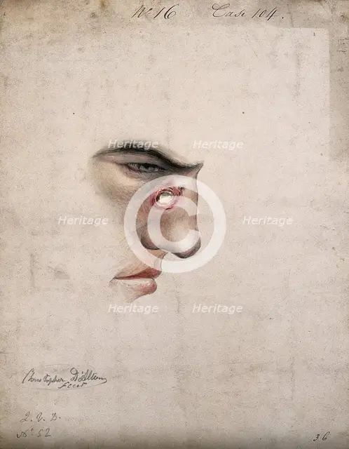 A detail of a man's face seen in profile with a severe disease affecting his nose, 1856. Creator: Christopher D'Alton.