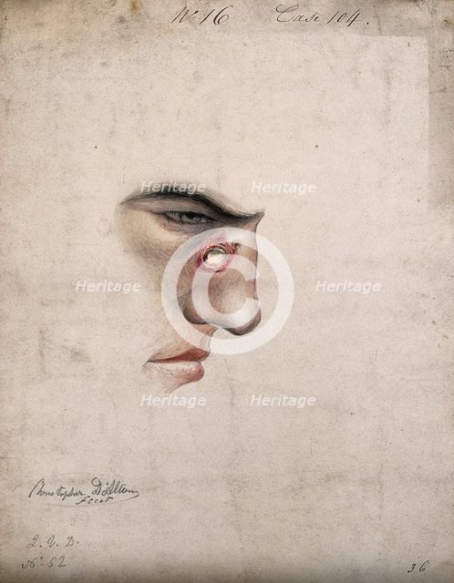 A detail of a man's face seen in profile with a severe disease affecting his nose, 1856. Creator: Christopher D'Alton.