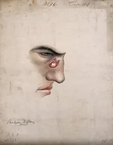 A detail of a man's face seen in profile with a severe disease affecting his nose, 1856. Creator: Christopher D'Alton