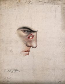A detail of a man's face seen in profile with a severe disease affecting his nose, 1856. Creator: Christopher D'Alton