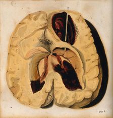 A diseased brain, 1800-1850. Creator: Richard Bright
