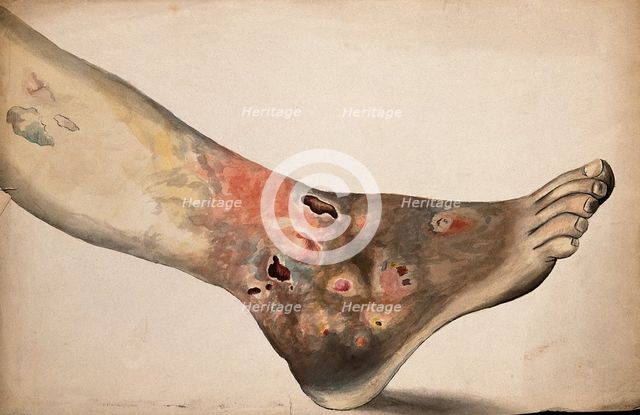 A diseased foot and lower leg. Creator: Unknown.