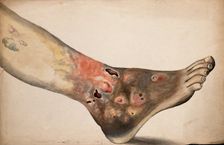 A diseased foot and lower leg. Creator: Unknown