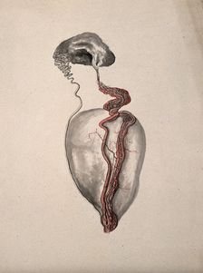 A diseased part of the body. Creator: Unknown
