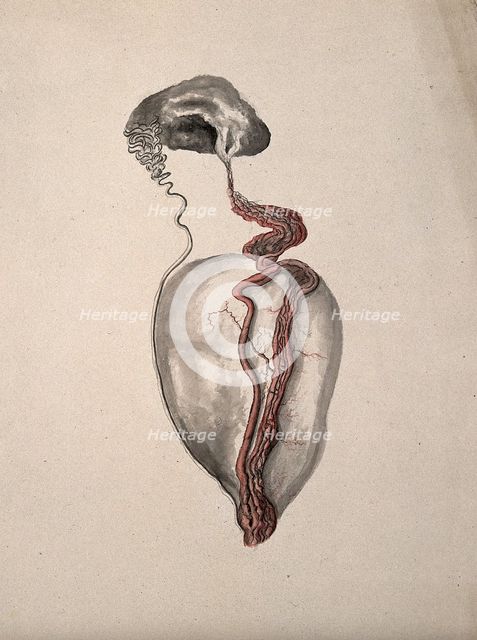 A diseased part of the body. Creator: Unknown.