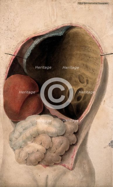 A dissected thorax with a collection of pus in the cavity, c1824. Creator: Unknown.