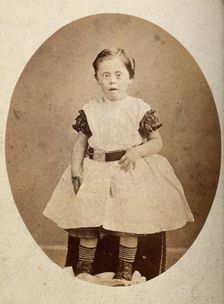 A girl with Down's syndrome, sitting, wearing striped socks, c1890s. Creator: Joseph Arthur Baldry