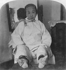 A high caste lady's dainty lily feet showing method of deformity China, 1900. Artist: Underwood & Underwood