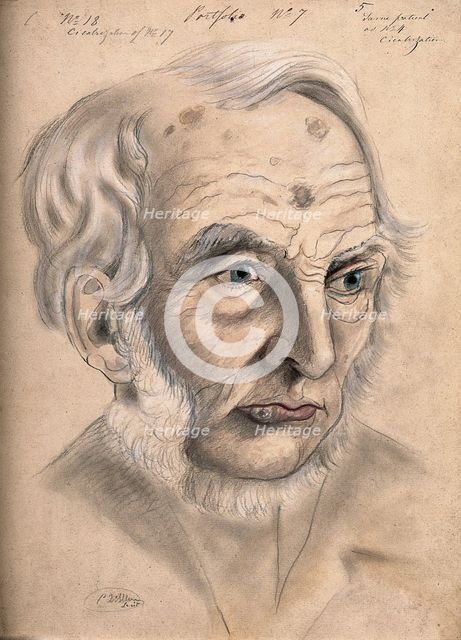 A man suffering from chancre of the lip, displaying scar tissue on his lower lip, forehead..., 1867. Creator: Christopher D'Alton.