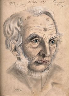 A man suffering from chancre of the lip, displaying scar tissue on his lower lip, forehead..., 1867. Creator: Christopher D'Alton