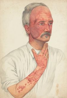 A man with disease designated as Lupus erythematosus, 1902. Creator: Mabel Green