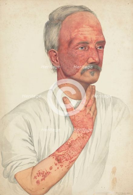 A man with disease designated as Lupus erythematosus, 1902. Creator: Mabel Green.