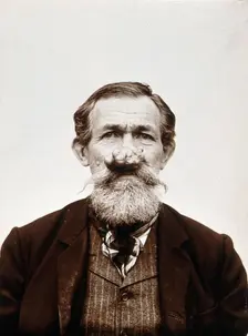 A patient of Léon Desguin, before operation, c1890s. Creator: Unknown