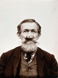A patient of Léon Desguin, before operation, c1890s. Creator: Unknown