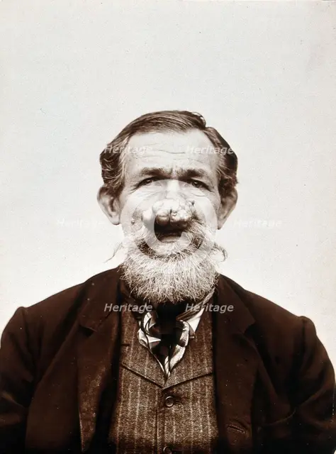 A patient of Léon Desguin, before operation, c1890s. Creator: Unknown.
