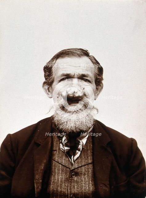 A patient of Léon Desguin, before operation, c1890s. Creator: Unknown.