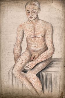A seated man suffering from a mottled rash of sores, which covers his entire body and face, 1858. Creator: Christopher D'Alton