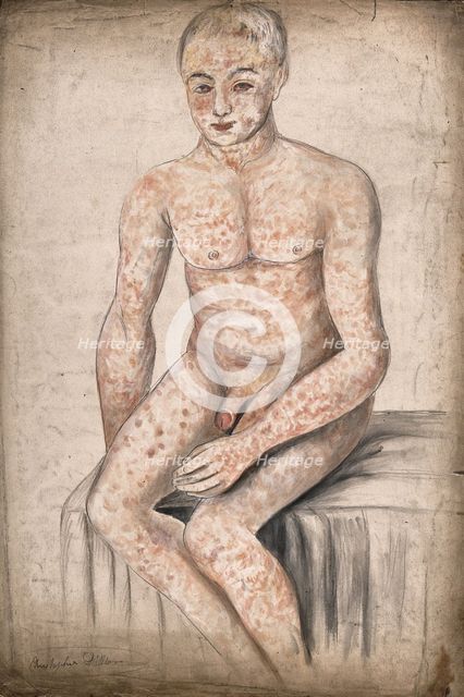 A seated man suffering from a mottled rash of sores, which covers his entire body and face, 1858. Creator: Christopher D'Alton.