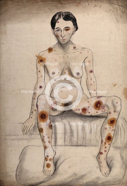 A seated woman displaying areas of diseased tissue on her entire body, face, genitals and eye, 1858. Creator: Christopher D'Alton.