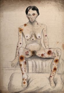 A seated woman displaying areas of diseased tissue on her entire body, face, genitals and eye, 1858. Creator: Christopher D'Alton