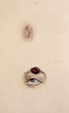 A section of a child's diseased forehead (detail); and a child's diseased eyebrow..., 1829. Creator: Unknown