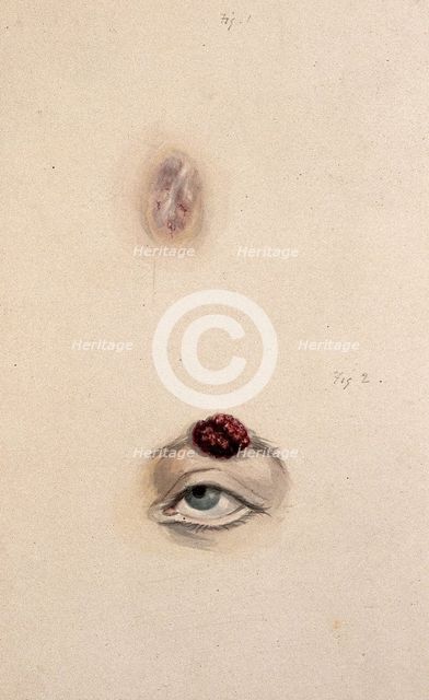 A section of a child's diseased forehead (detail); and a child's diseased eyebrow..., 1829. Creator: Unknown.