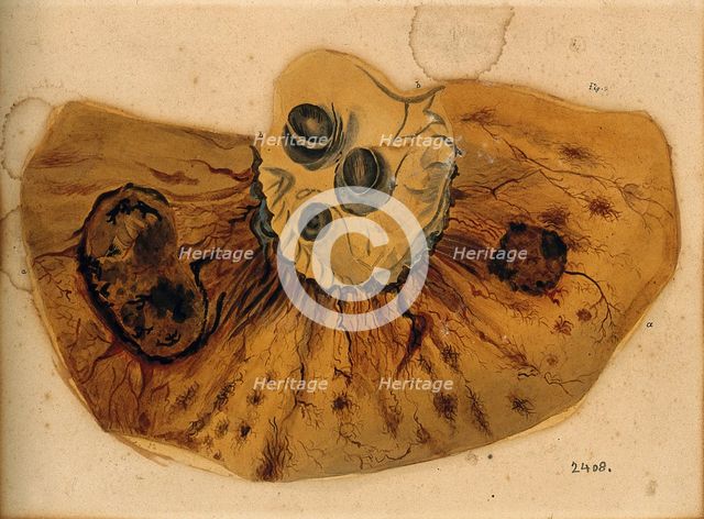 A section of diseased intestine or heart, 1800-1850. Creator: Richard Bright.