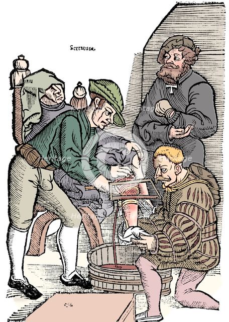 Amputation of a leg without anaesthetic, 1593. Artist: Unknown.