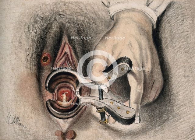An infected sore on the female genitalia shown with the aid of a vaginal speculum, 1800-1899. Creator: Christopher D'Alton.